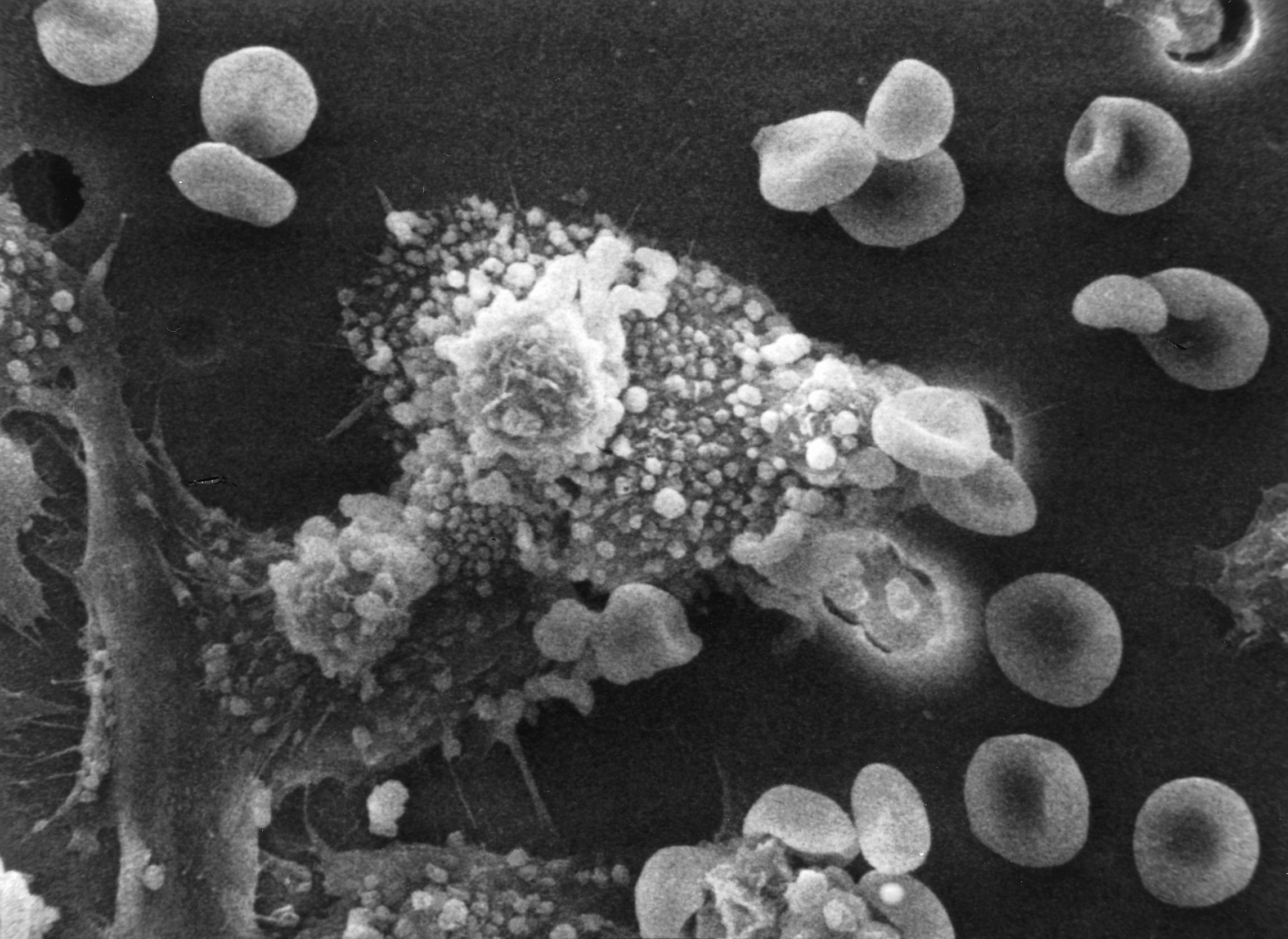 Macrophages engulfing tumor cells, via same mechanism as pathogenic cells
