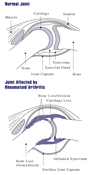 Diagram showing a normal joint and a joint suffering from arthritis